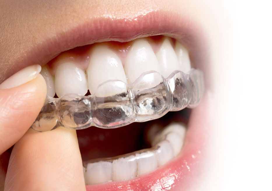 Invisalign for adult