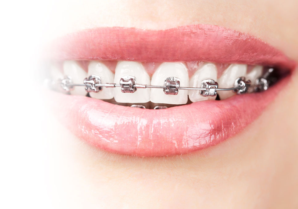 Metal braces