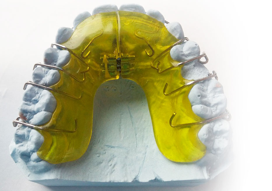 Palatal expander