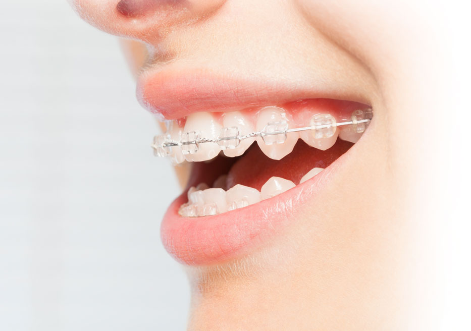 Ceramic braces